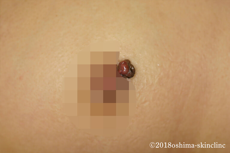 乳頭線維腫 (にゅうとうせんいしゅ）