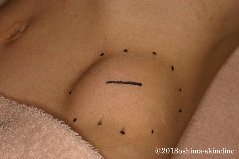 脂肪腫/多発性脂肪腫