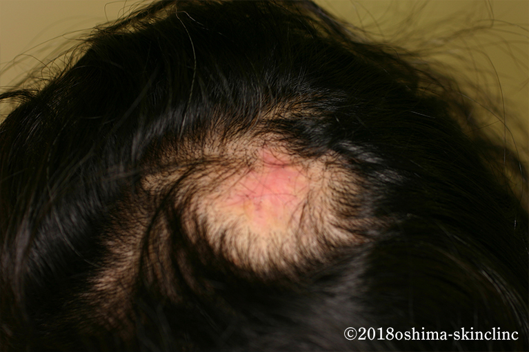 肥厚性瘢痕及びケロイド