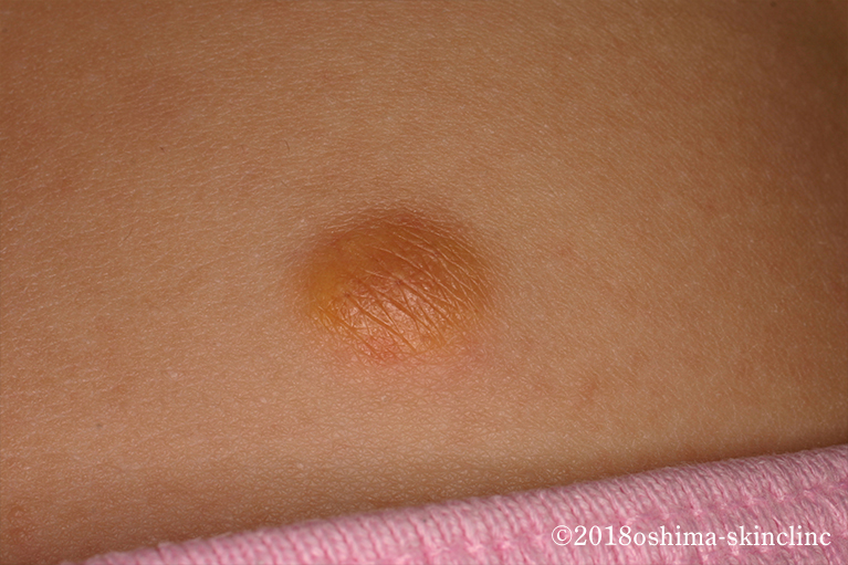 若年性黄色肉芽腫