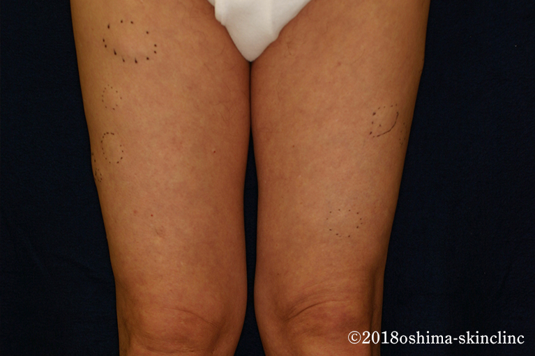 多発性脂腺囊腫