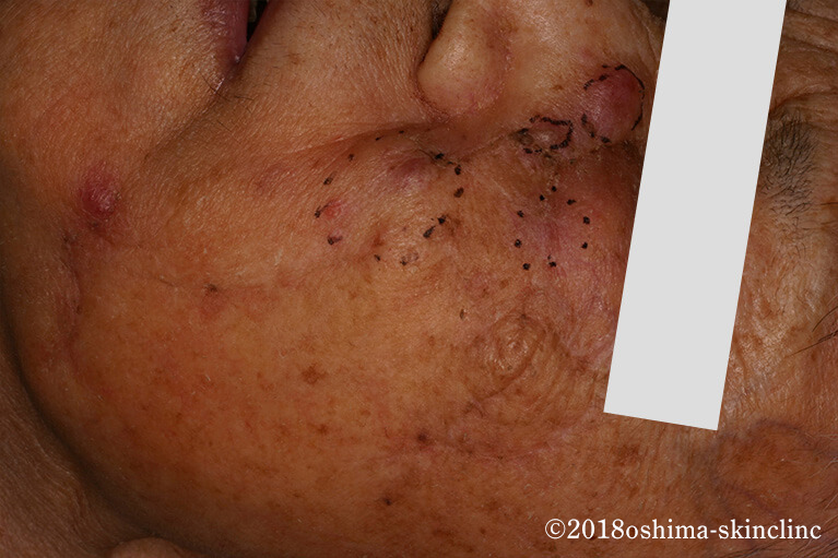 メルケル細胞癌