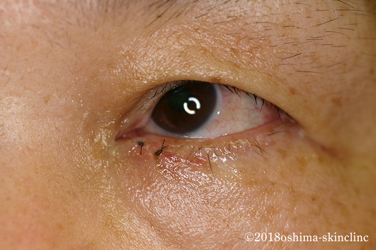 ボーエン病（Bowen病）