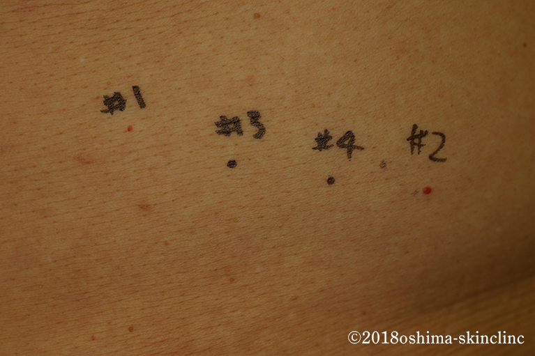 血管肉腫（脈管肉腫）