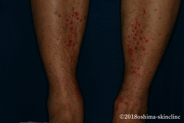 アナフィラクトイド紫斑病