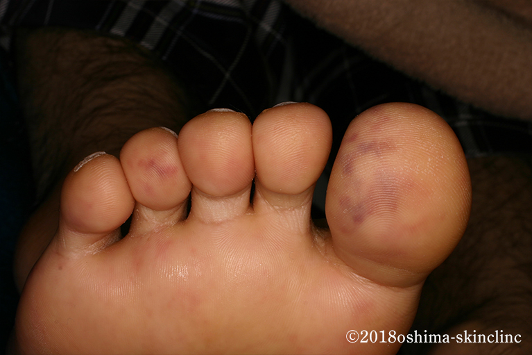 コレステロール血症塞栓症