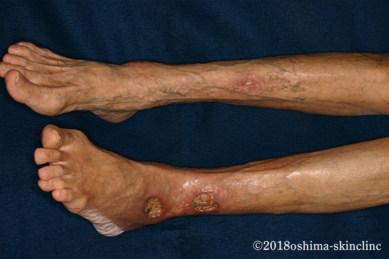 結節性多発動脈炎