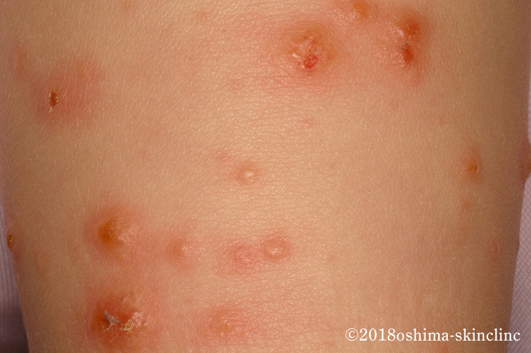 ウイルス性発疹症