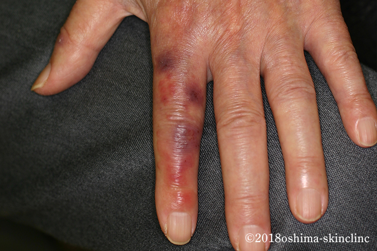 ヘルペス性ひょうそ