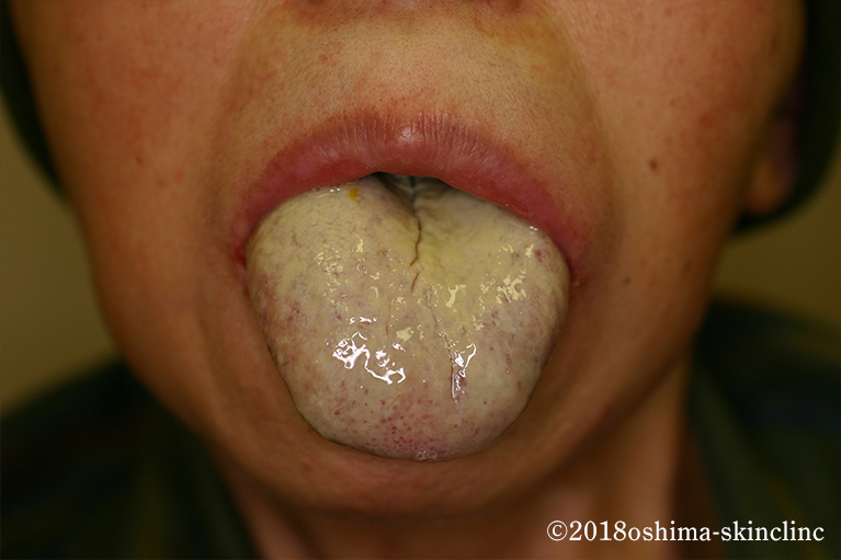 口腔内カンジダ症