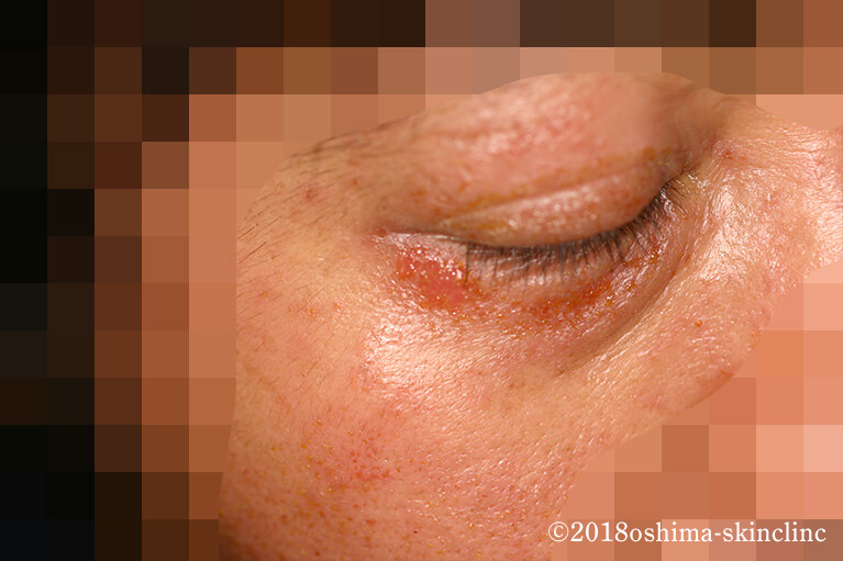 伝染性膿痂疹（とびひ）