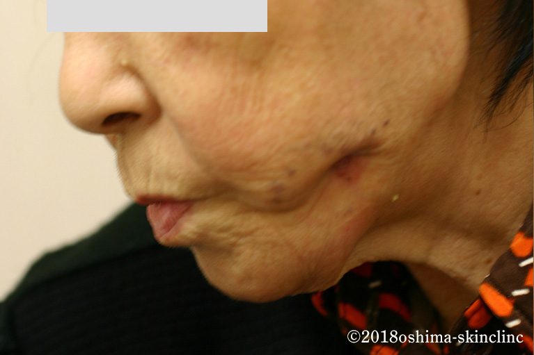 その他の特殊な細菌感染/外歯瘻（がいしろう）