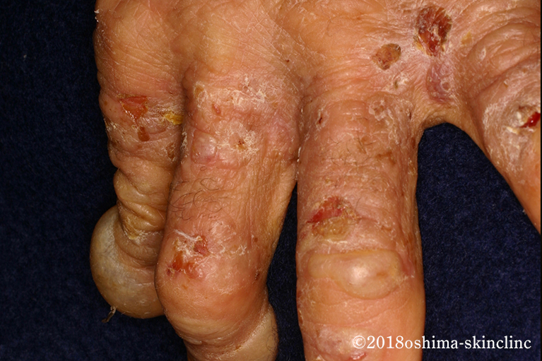 白癬（はくせん）