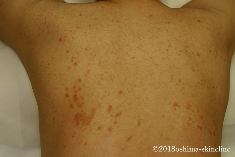 皮膚アミロイドーシス