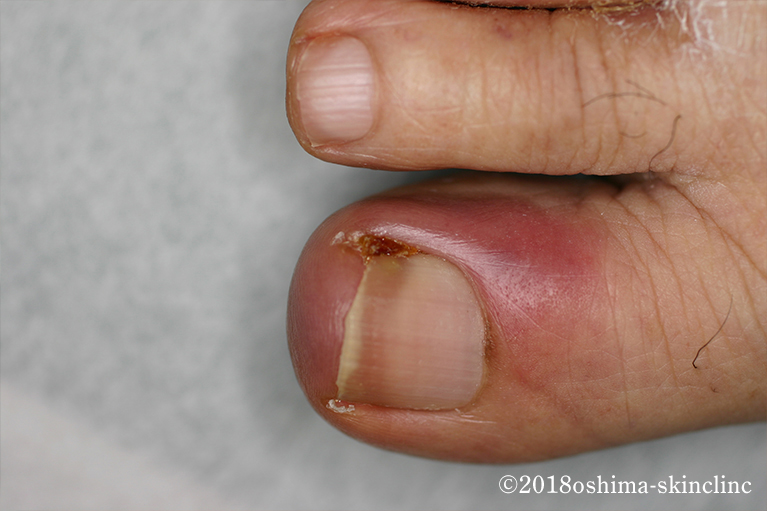 爪甲の変化