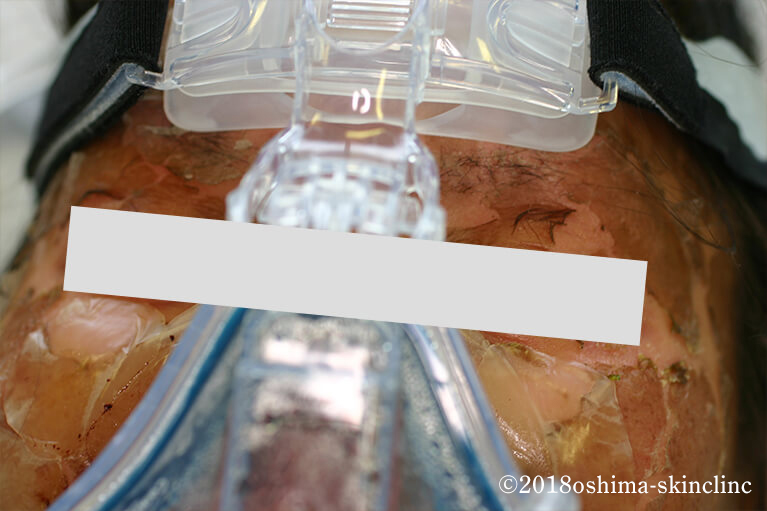 ＴＥＮ/中毒性表皮壊死症