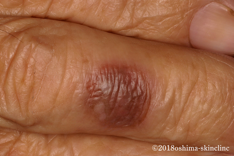 多発性固定薬疹