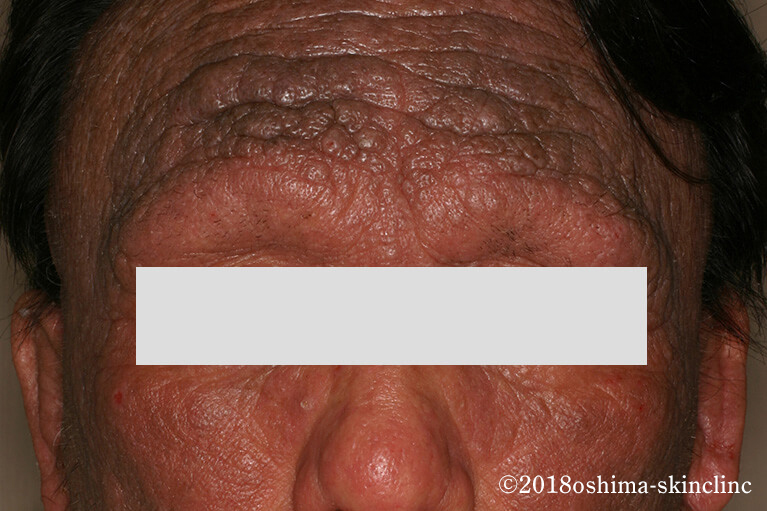 アトピー性皮膚炎