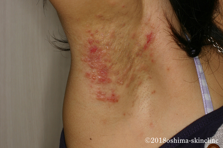 汗疹かヘルペスかとびひ