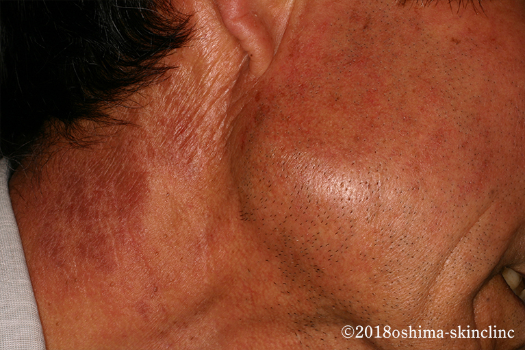 光線過敏性皮膚炎